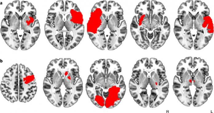 cerebrolesiones